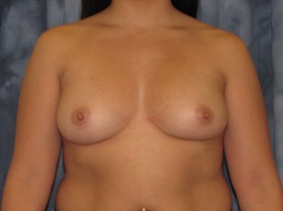 Breast Augmentation Patient 10