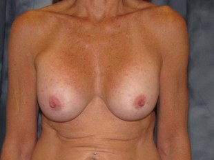 Breast Augmentation with Lift Patient 5