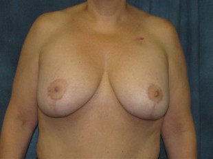 Breast Augmentation with Lift Patient 15