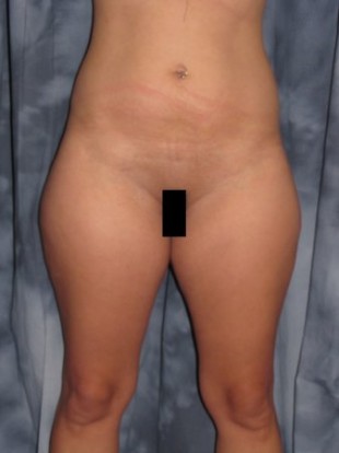Liposuction Patient 2