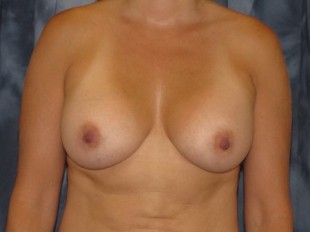 Breast Augmentation Patient 7