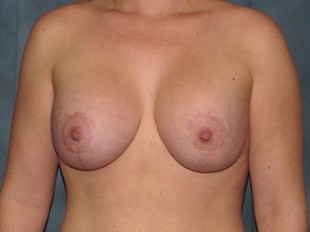 Breast Augmentation with Lift Patient 11