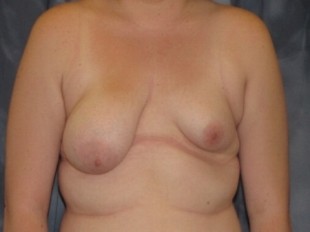 Breast Augmentation with Lift Patient 18