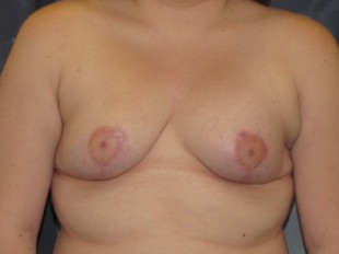 Breast Augmentation with Lift Patient 18