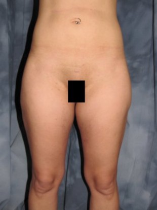 Liposuction Patient 2