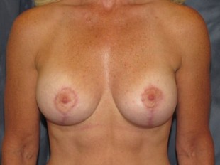 Breast Augmentation with Lift Patient 13