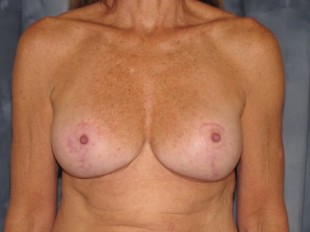 Breast Augmentation with Lift Patient 5