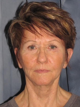 Facelift Patient 2