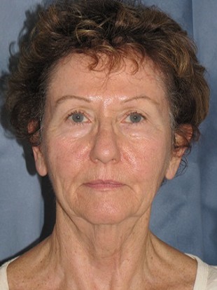 Facelift Patient 2