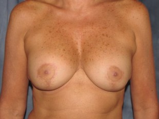 Breast Augmentation with Lift Patient 8