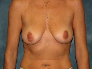 Breast Augmentation with Lift Patient 1