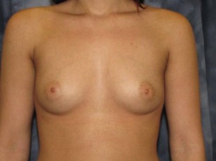 Breast Augmentation Patient 6