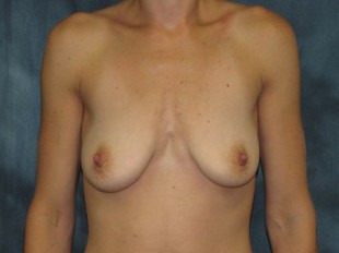 Breast Augmentation with Lift Patient 9