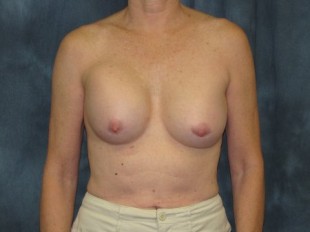 Breast Implant Exchange Patient 4