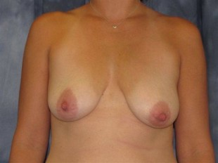 Breast Augmentation with Lift Patient 10