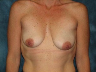 Breast Augmentation with Lift Patient 17