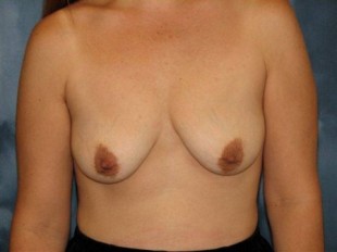 Breast Augmentation with Lift Patient 19