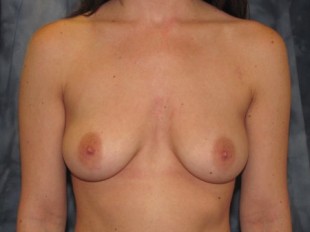 Breast Augmentation with Lift Patient 3