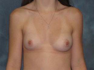 Breast Augmentation Patient 3