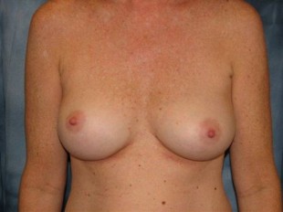 Breast Implant Exchange Patient 5