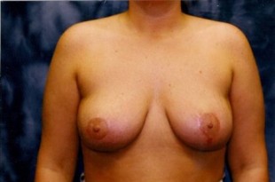 Breast Lift Patient 3