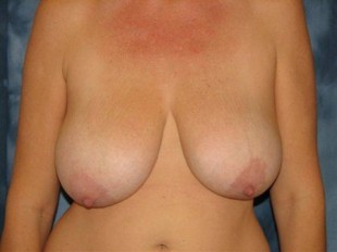 Breast Reduction Patient 2