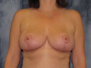 Breast Reduction Patient 3