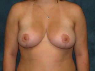 Breast Reduction Patient 1