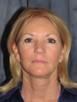 Facelift Patient 10