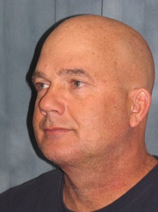 Male Patient 7 – facelift