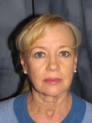 Facelift Patient 4