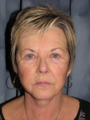 Facelift Patient 1