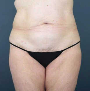 Tummy Tuck Patient 17