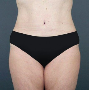 Tummy Tuck Patient 17