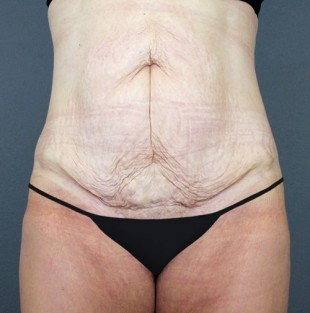 Tummy Tuck Patient 15