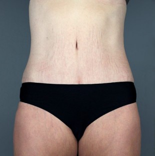 Tummy Tuck Patient 15