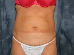 Liposuction Patient 11