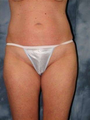 Liposuction Patient 4