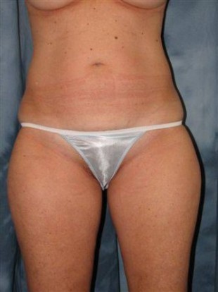 Liposuction Patient 4