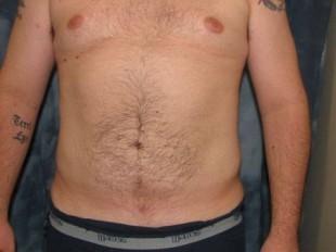 Male Patient 2 – Liposuction