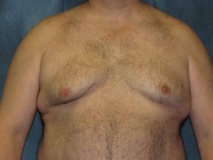 Liposuction Patient 10