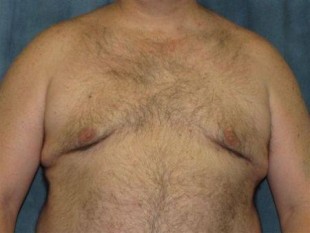 Liposuction Patient 10