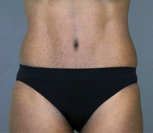 Tummy Tuck Patient 18