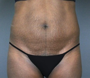 Tummy Tuck Patient 18