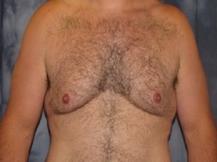 Male Patient 8 – Body Contouring