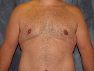 Male Patient 8 – Body Contouring