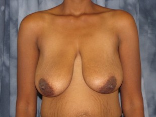 Breast Lift Patient 2