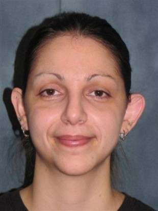 Rhinoplasty Patient 6