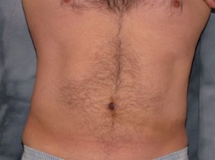Male Patient 6 – liposuction of the torso