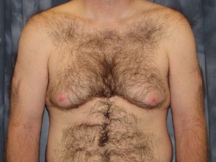 Male Patient 4 – Gynecomastia